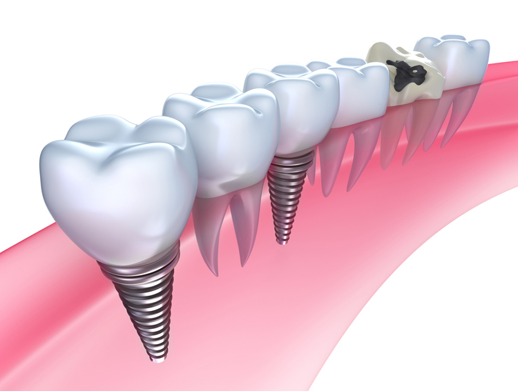 Are There any Risks to Dental Implants