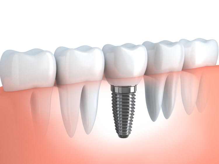 Procedure for Placing Dental Implants