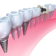pictures of dental implants
